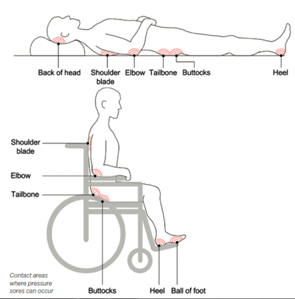 Common contact areas where pressure sores may develop Top diagram highlights the potential pressure sore areas at the back of head, shoulder blade, elbow, tailbone, buttocks and the heel on a person lying flat on the bed.